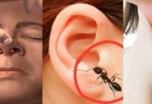 নাক-কান-গলায় কিছু ঢুকে গেলে কী করতে হবে? নাক-কান-গলায় কিছু ঢুকে গেলে